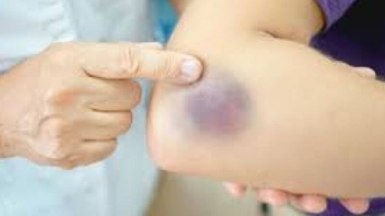 لکه‌های آبی روی پوست نشانه کدام بیماری خطرناک است؟