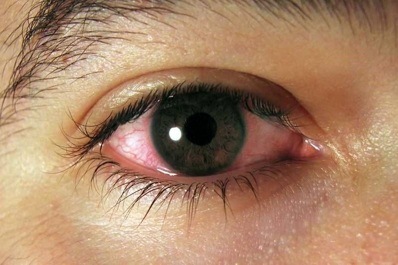 آبسه چشم چیست و چرا چشم عفونت می کند؟