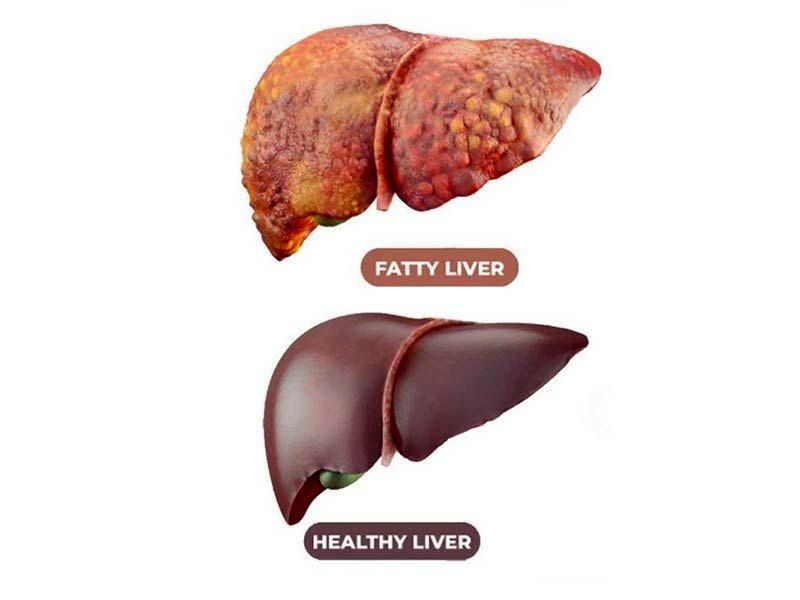علائم هشداردهنده ابتلا به کبد چرب را بشناسید!