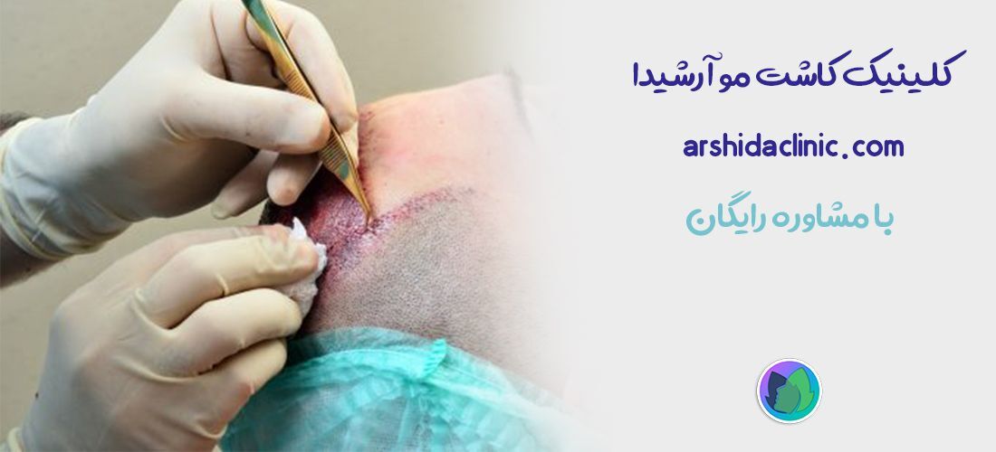 مشاوره رایگان کاشت مو | کلینیک تخصصی کاشت مو آرشیدا کلینیک | قیمت کاشت هر تار مو به روش چقدر است ؟
