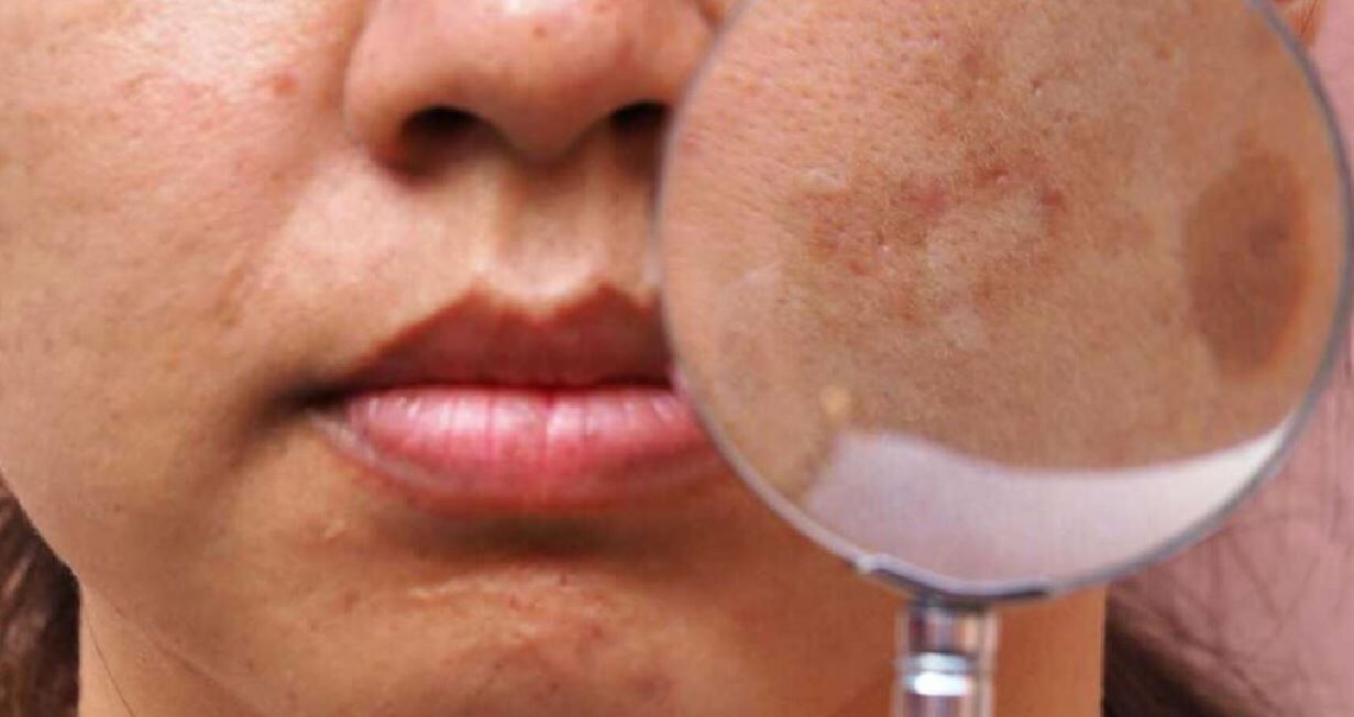 علت لکه‌های سیاه روی پوست چیست؟