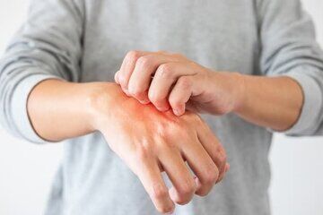 علائم یک بیماری خطرناک که روی پوست ظاهر می‌شوند