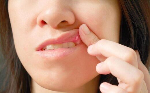 علت اصلی آفت‌های دهان چیست؟/روش های درمان