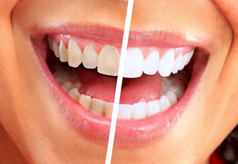 افشای رازهای مهم سلامتی شما با رنگ دندان هایتان / خطرناک ترین لکه چه رنگی است؟