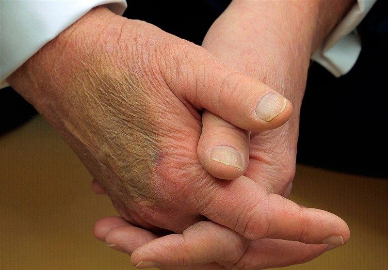 تلاش ترامپ برای پنهان کردن کبودی مزمن دست راست​/ بیماری او چیست؟