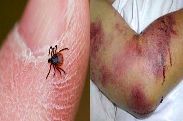 فوت دومین بیمار مبتلا به تب کریمه کنگو در ایران