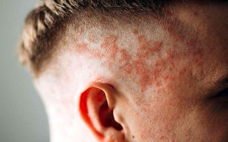 علائم اگزمای پوست سر را بشناسید / اگزما با شوره سر چه تفاوتی دارد؟ 2