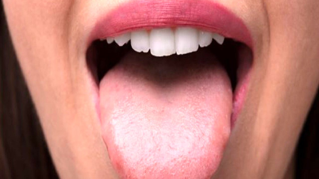 سرطان زبان را با این 3 نشانه تشخیص دهید