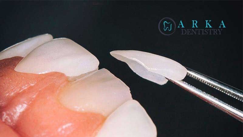 لمینت سرامیکی چیست؟