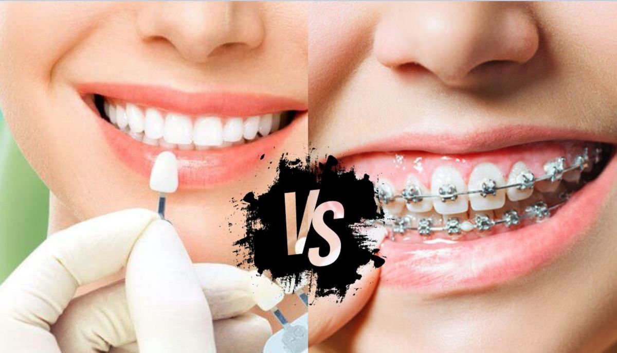 ارتودنسی بهتر است یا لمینت دندان؟