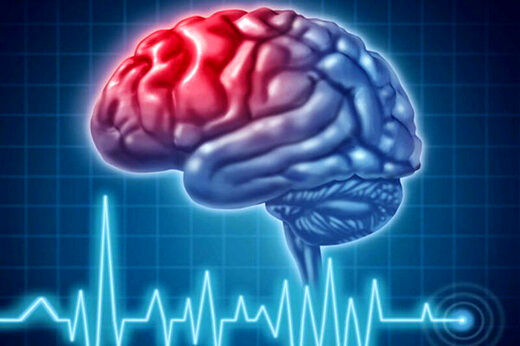 علائم مهم سکته مغزی کدام است؟