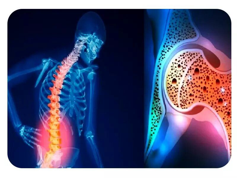 برای افزایش تراکم استخوان چه بخوریم؟ 3