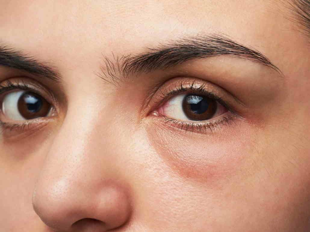 همه دلایل پف زیر چشم + راهکار درمانی