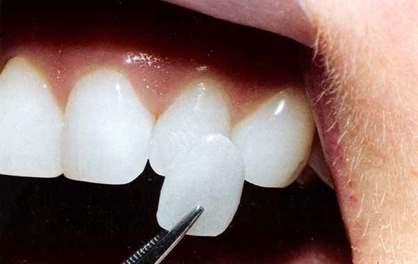اگر جزو این 6 گروه هستید نباید دندان هایتان را لمینت کنید!
