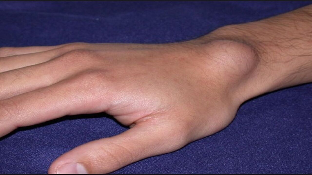 نکات مهم درباره تومور استخونی