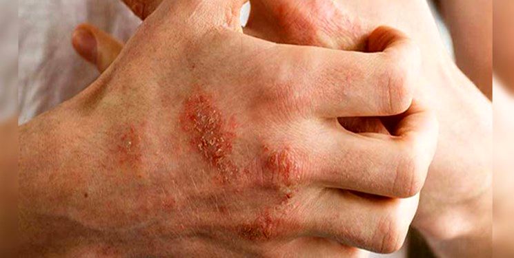 این بیماری پوستی شایع در پاییز و زمستان را بیشتر بشناسید!