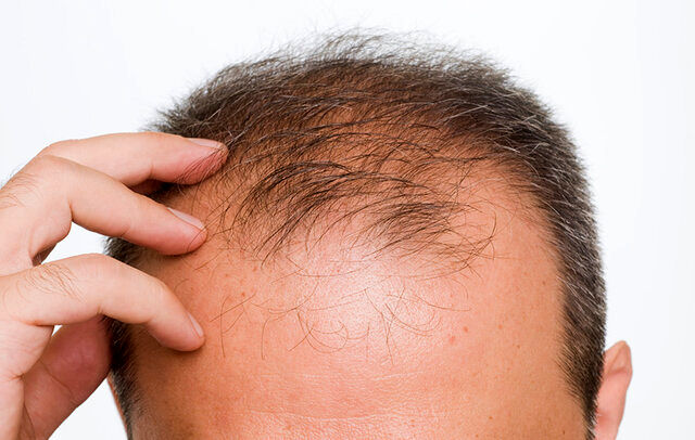 یک عامل تشدیدکننده ریزش مو 