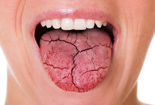 تاثیر میزان قند خون در ایجاد خشکی دهان چقدر است؟