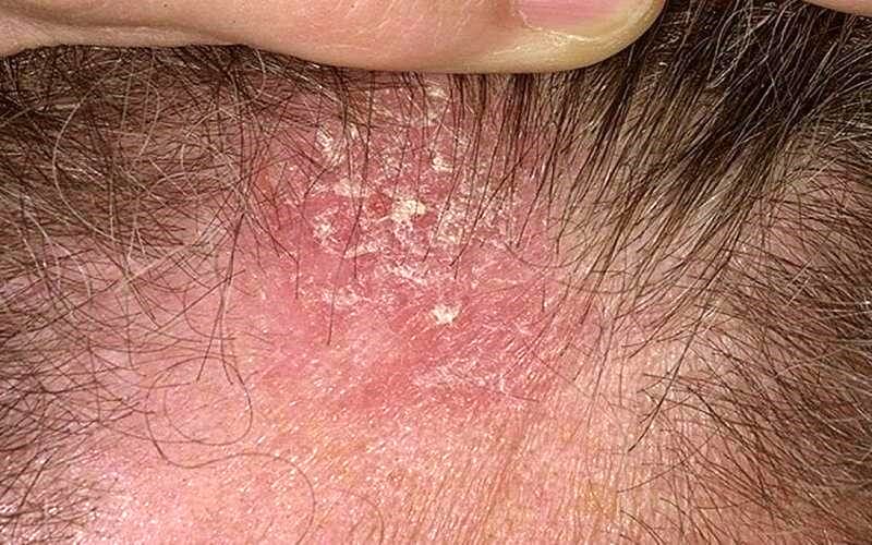 علائم اگزمای پوست سر را بشناسید / اگزما با شوره سر چه تفاوتی دارد؟ 3